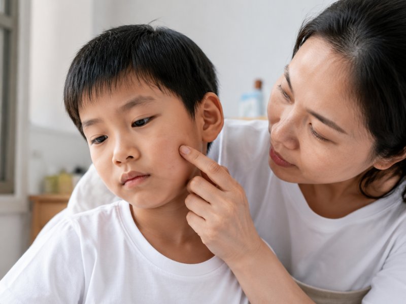 小孩脸上长扁平疣怎么办?要不要去医院治疗?
