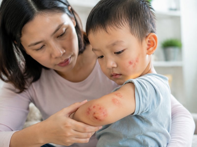 孩子身上长脓疱会不会是脓疱疮?怎么判断典型症状?