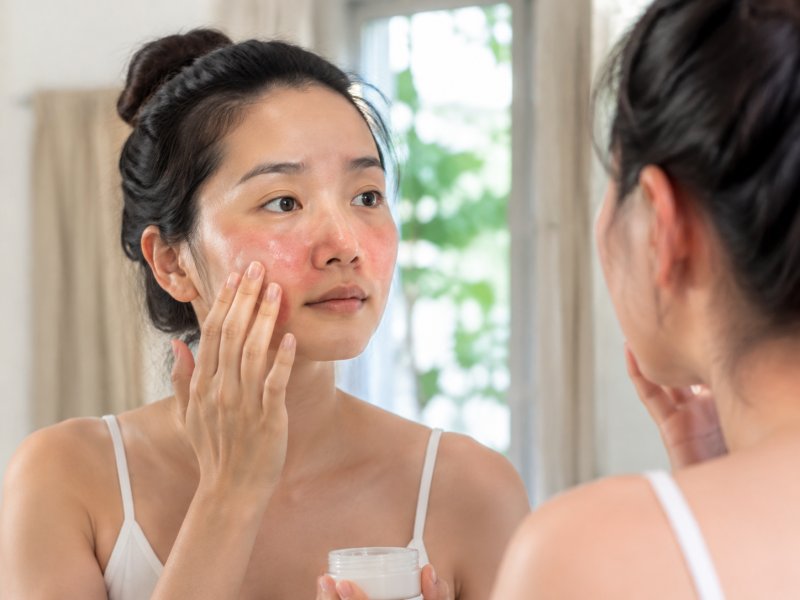 酒糟鼻一到夏天就加重，闷热环境里该怎么护理才能少发红