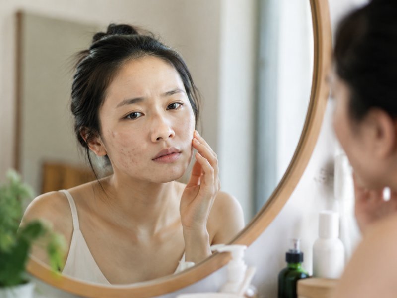 为什么过了25岁还长痘？成人青春痘和青春期痤疮有什么不同