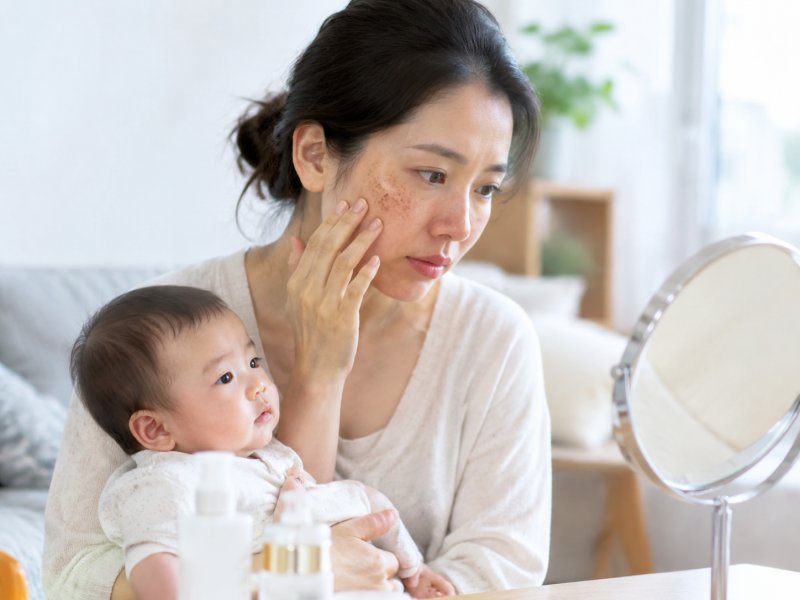生完孩子后黄褐斑多久能退？哺乳期要不要急着做激光治疗