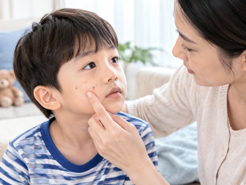 孩子脸上长了扁平疣怎么处理,要不要跟大人的治疗方式分开来?