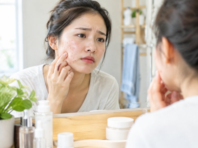 脸上反复长痘是什么原因?内分泌和护肤品哪个影响更大?